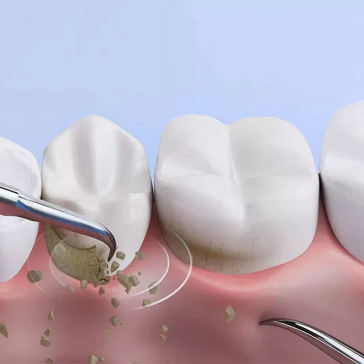 Dental Calculus Plaque Removal Tool